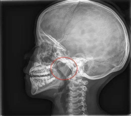 Raio-x de cavum em perfil lateral, com a região da adenoide destacada em vermelho atrás do nariz
