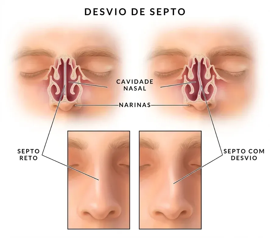 Ilustração comparando um septo nasal reto com um septo nasal desviado, mostrando a cavidade nasal, as narinas e o aspecto externo do nariz em cada caso