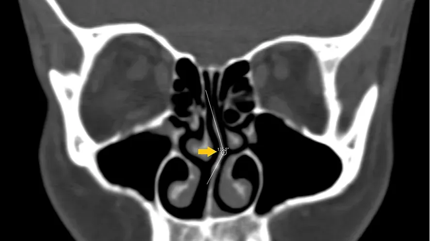 Tomografia computadorizada dos seios da face em corte coronal, com medição do ângulo de desvio do septo nasal marcado em 13,5 graus
