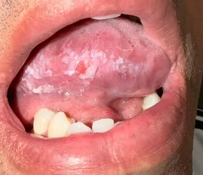 Lesão na borda lateral da língua, com placa esbranquiçada e uma área avermelhada no centro