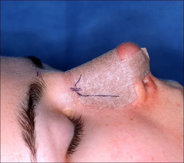 Perfil de paciente no pós-operatório de rinoplastia, com curativo sobre o dorso nasal e marcações do planejamento cirúrgico