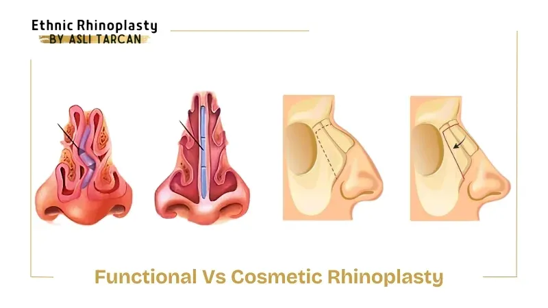 Comparação entre cirurgia funcional e cirurgia estética do nariz: cortes internos mostrando o septo e as estruturas de passagem do ar ao lado do perfil externo do nariz