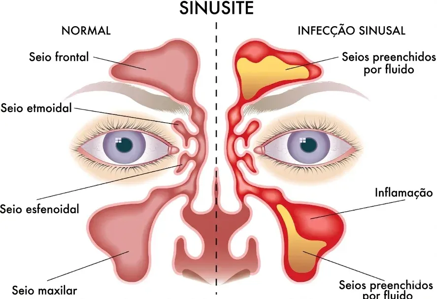 Ilustração comparando os seios da face saudáveis com os seios inflamados e preenchidos por fluido durante uma sinusite, ao redor dos olhos, da testa e das maçãs do rosto