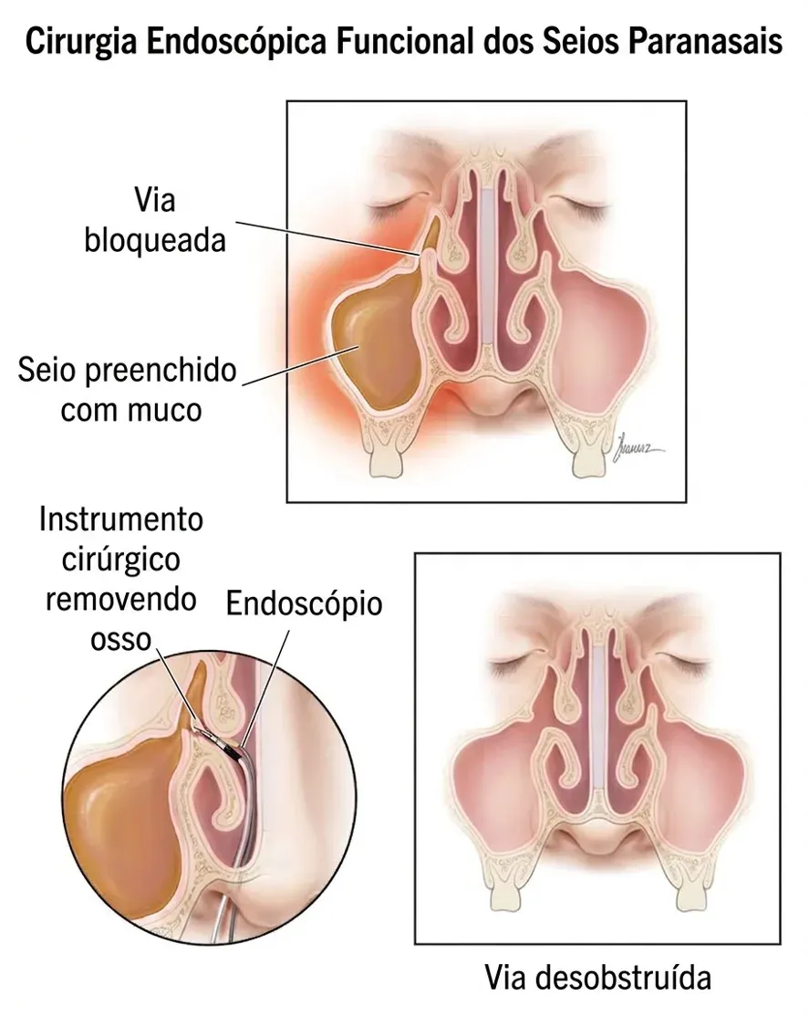 Ilustração da cirurgia endoscópica funcional dos seios paranasais, mostrando a via bloqueada e o seio preenchido por muco antes do procedimento e a via nasal desobstruída depois